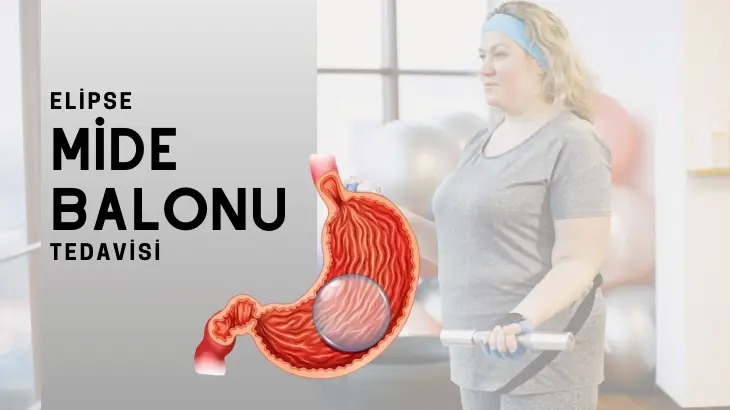 Mide Balonu Fiyatlarını Araştırırken Önce Bilinmesi Gerekenler
